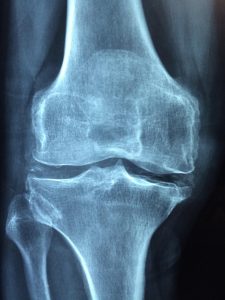 knee, old, care, injury, pain, knee pain, inflammation, osteoarthritis, medical, arthritis, joint pain, health, x, x-ray, skeleton, medicine, anatomy, anatomical, diagnosis, painful, rheumatism, bone, leg, disease, human, cartilage, joint, skeletal, osteoporosis, blue health, blue medical, blue pain, blue medicine, blue human, blue care, blue old, knee, pain, knee pain, knee pain, knee pain, osteoarthritis, arthritis, arthritis, arthritis, arthritis, joint pain, joint pain, joint pain, joint pain, joint, osteoporosis, osteoporosis, osteoporosis, osteoporosis, osteoporosis